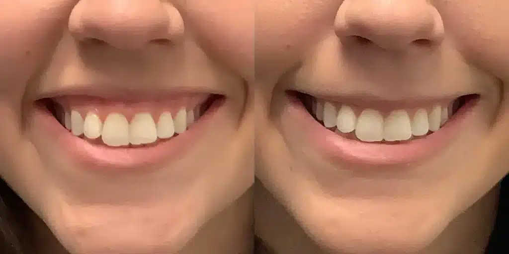 botox before and after photos by revitalize skinmd in waco tx