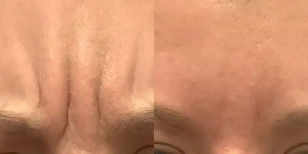 botox before and after photos by revitalize skinmd in waco tx