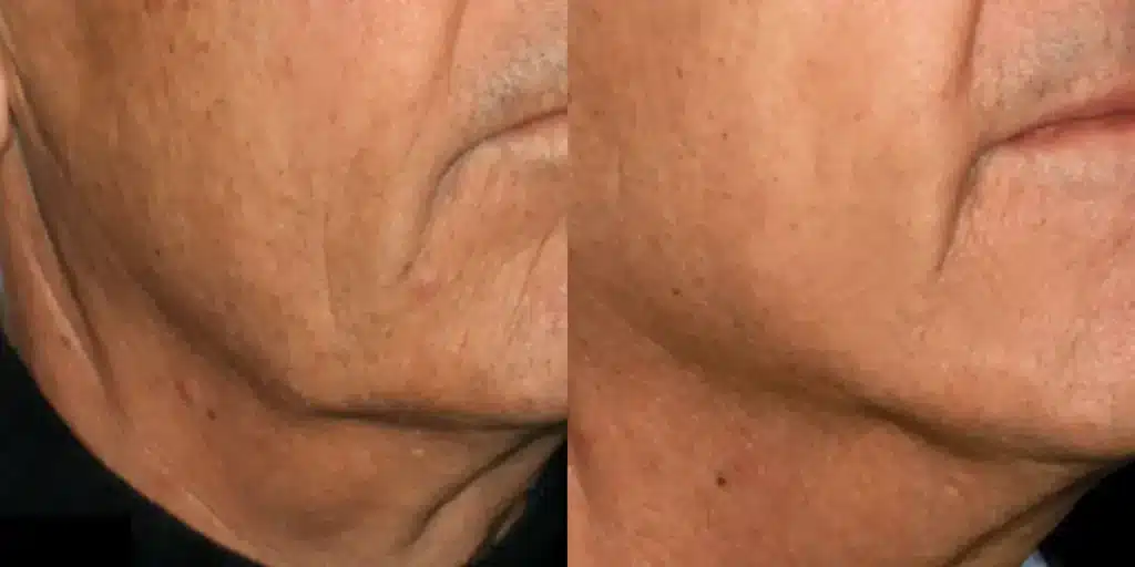 genius rf microneedling before and after photos by revitalize skinmd in waco tx
