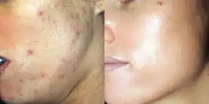 perfect derma peel before and after photos by revitalize skinmd in waco tx