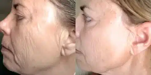 perfect derma peel before and after photos by revitalize skinmd in waco tx