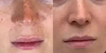 perfect derma peel before and after photos by revitalize skinmd in waco tx