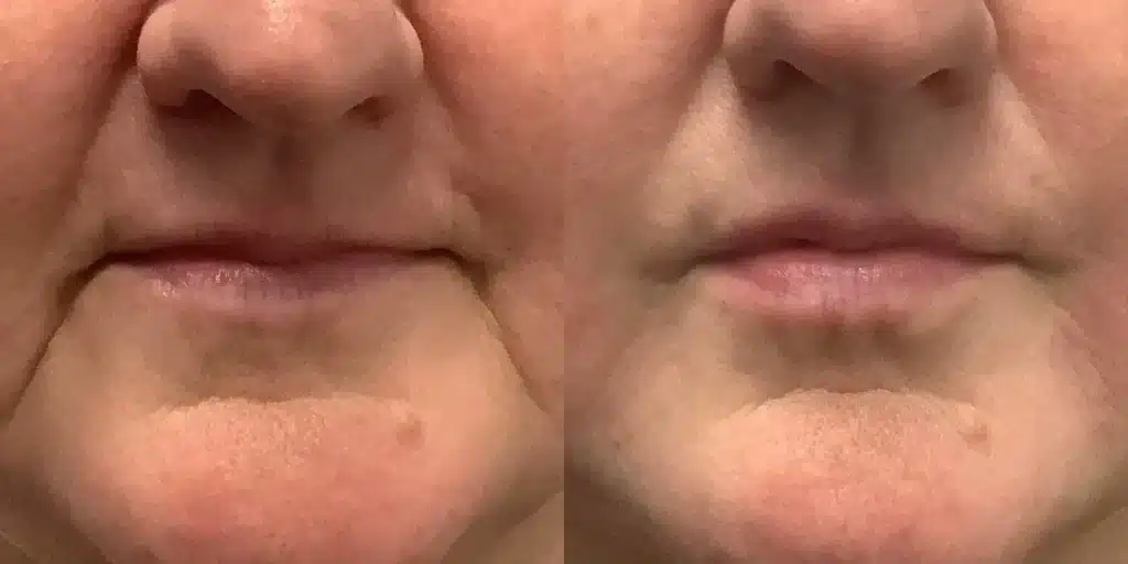dermal Fillers aaa before and after photos by revitalize skinmd in waco tx
