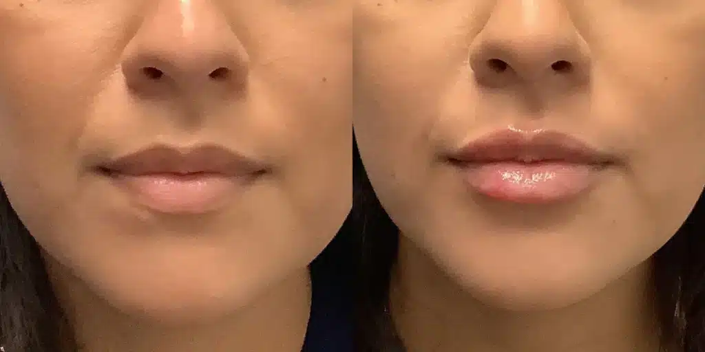 dermal Fillers aaa before and after photos by revitalize skinmd in waco tx