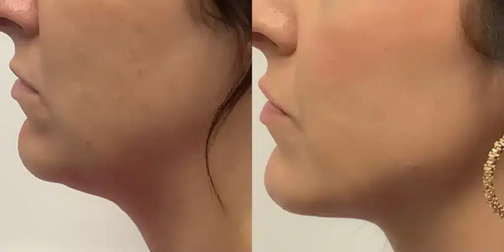 dermal Fillers aaa before and after photos by revitalize skinmd in waco tx