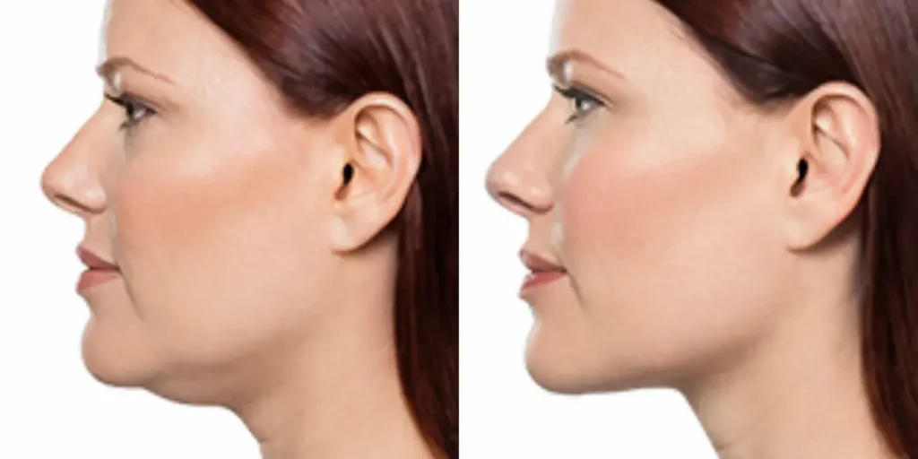 dermal Fillers aaa before and after photos by revitalize skinmd in waco tx