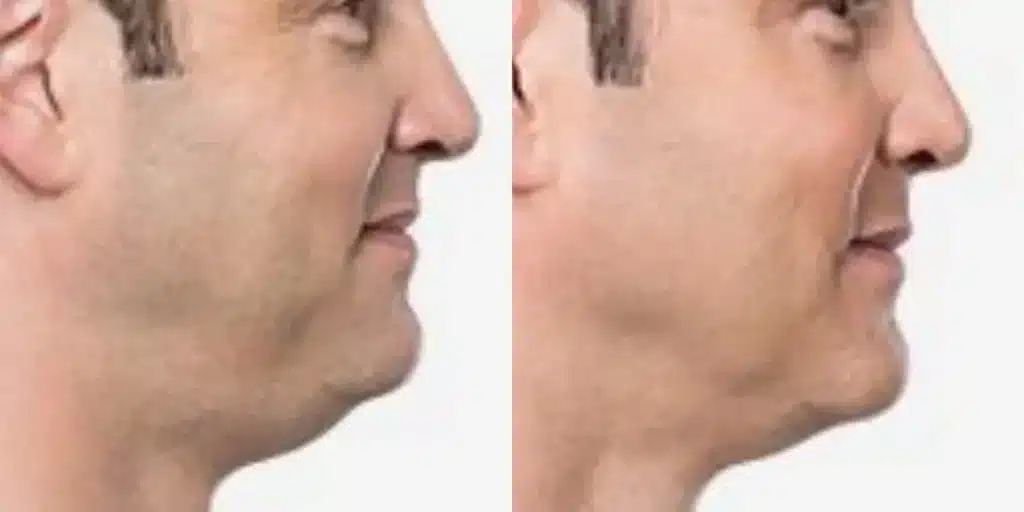 dermal Fillers aaa before and after photos by revitalize skinmd in waco tx