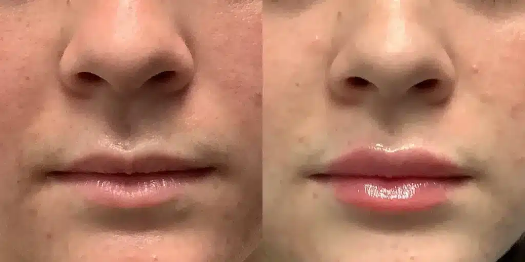 dermal Fillers aaa before and after photos by revitalize skinmd in waco tx