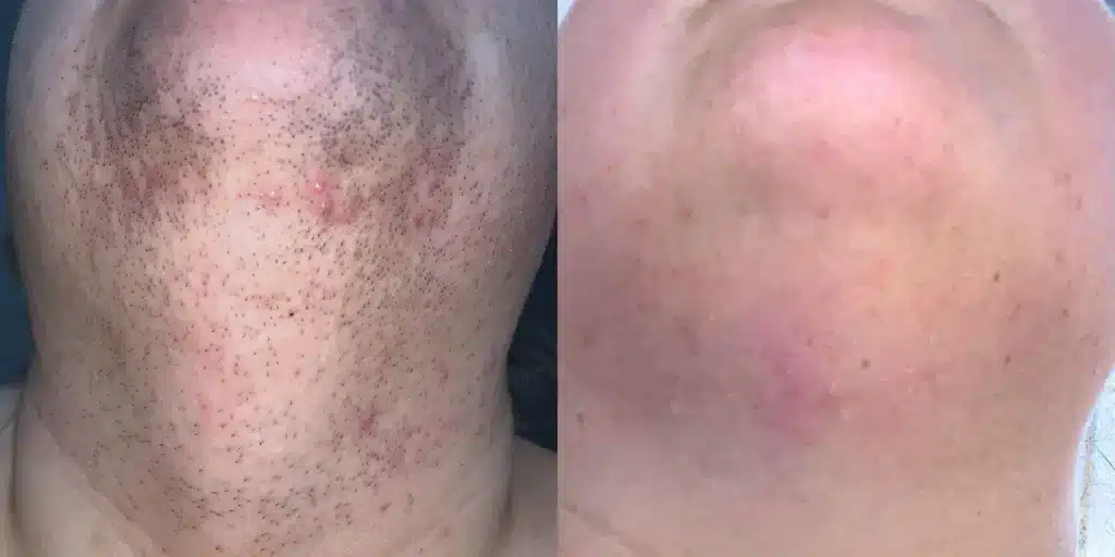 laser hair removal before and after photos by revitalize skinmd in waco tx