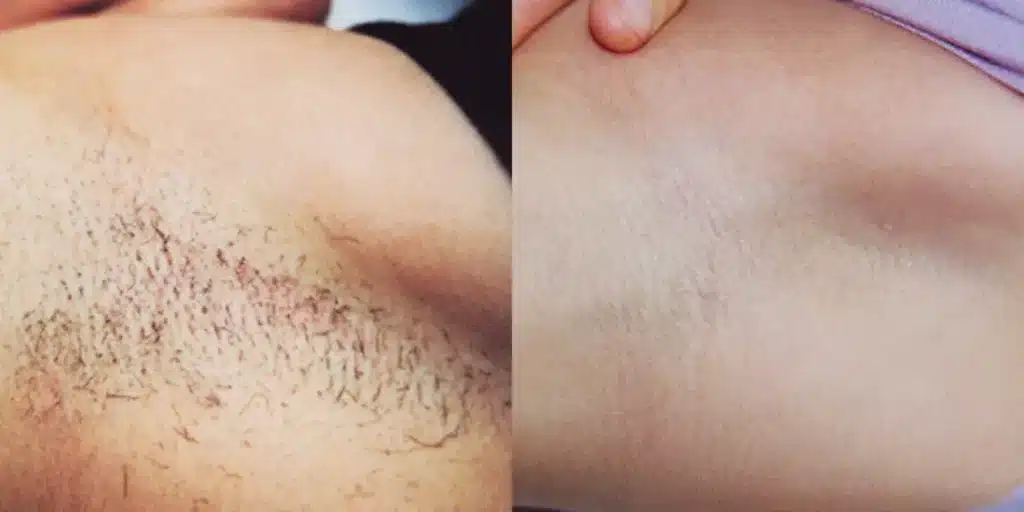 laser hair removal before and after photos by revitalize skinmd in waco tx