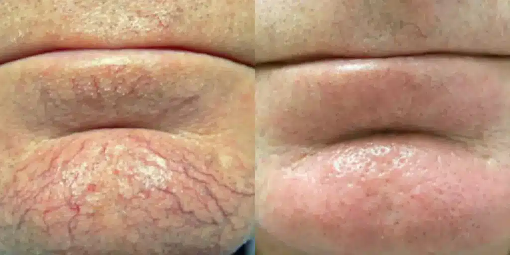 laser vein removal before and after photos by revitalize skinmd in waco tx