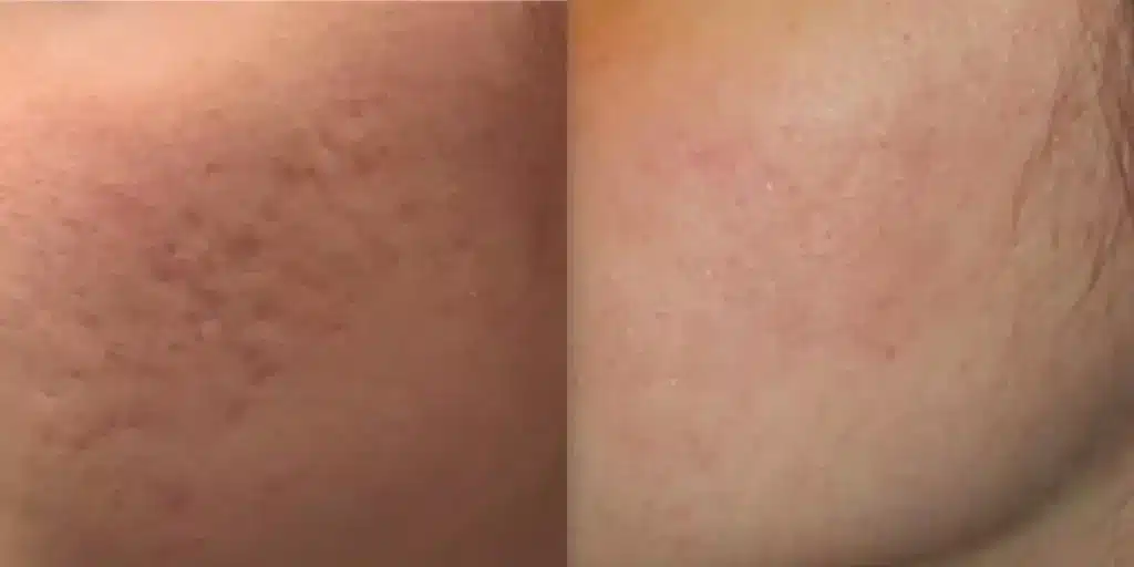 skinpen microneedling before and after photos by revitalize skinmd in waco tx