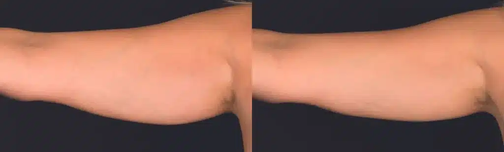 coolsculpting elite before and after photos by revitalize skinmd in waco tx