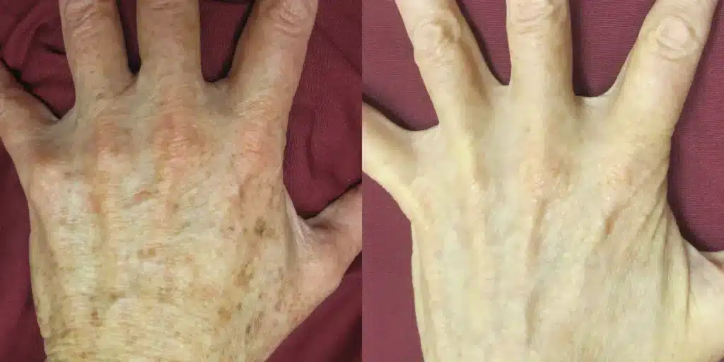 broadband light photofacial before and after photos by revitalize skinmd in waco tx