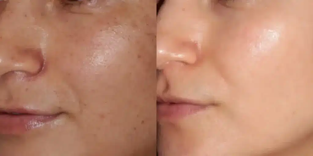 broadband light photofacial before and after photos by revitalize skinmd in waco tx