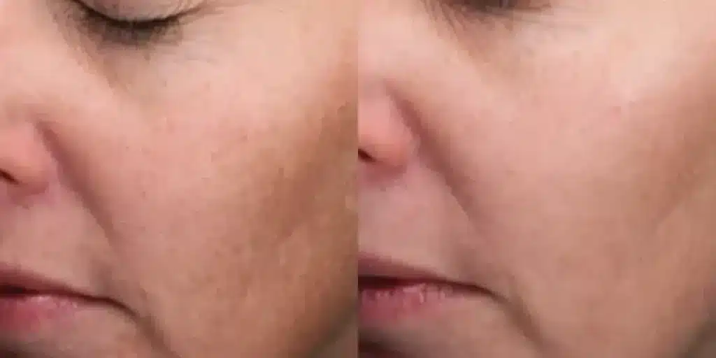 moxi laser resurfacing before and after photos by revitalize skinmd in waco tx