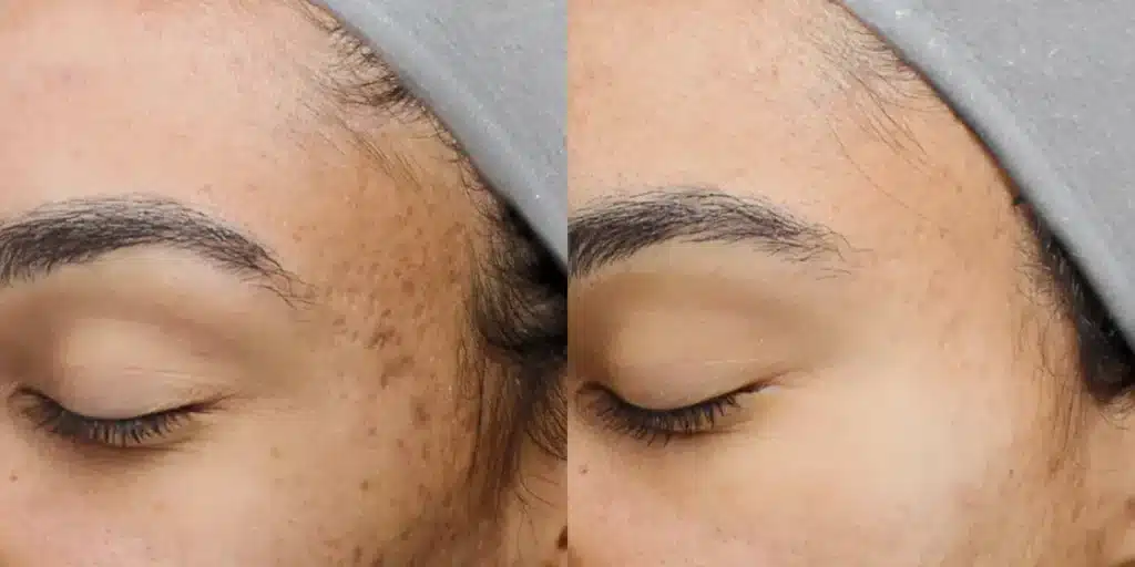 moxi laser resurfacing before and after photos by revitalize skinmd in waco tx