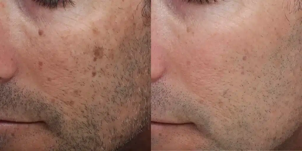 moxi laser resurfacing before and after photos by revitalize skinmd in waco tx