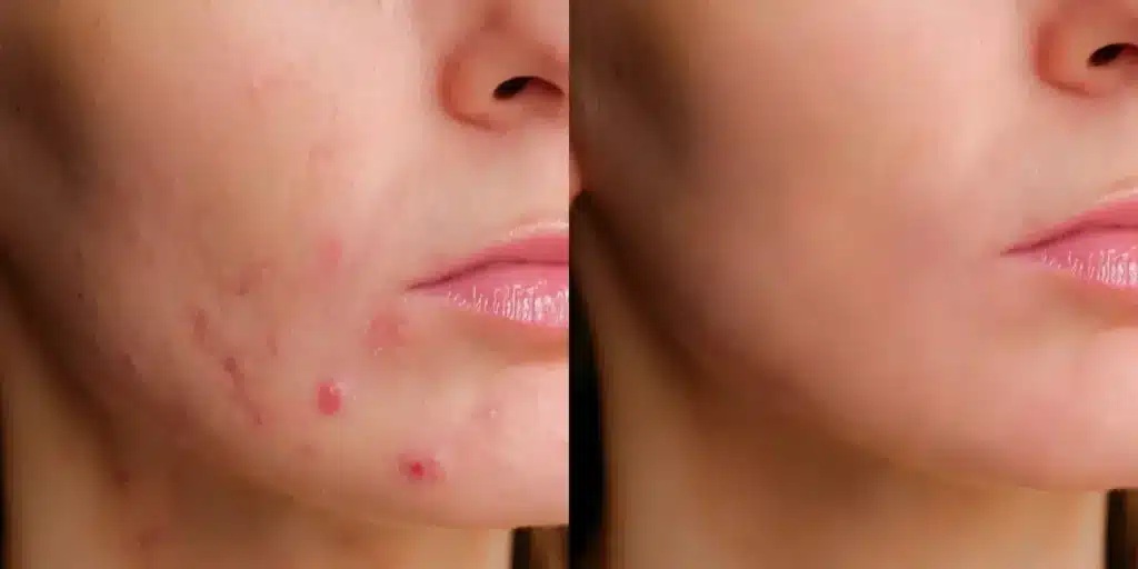 facials before and after photos by revitalize skinmd in waco tx