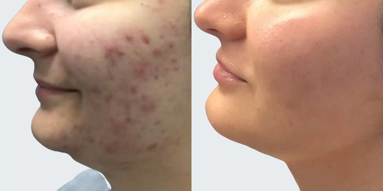 before and after results of bbl at revitalize skinmd before and after results of bbl at revitalize skinmd