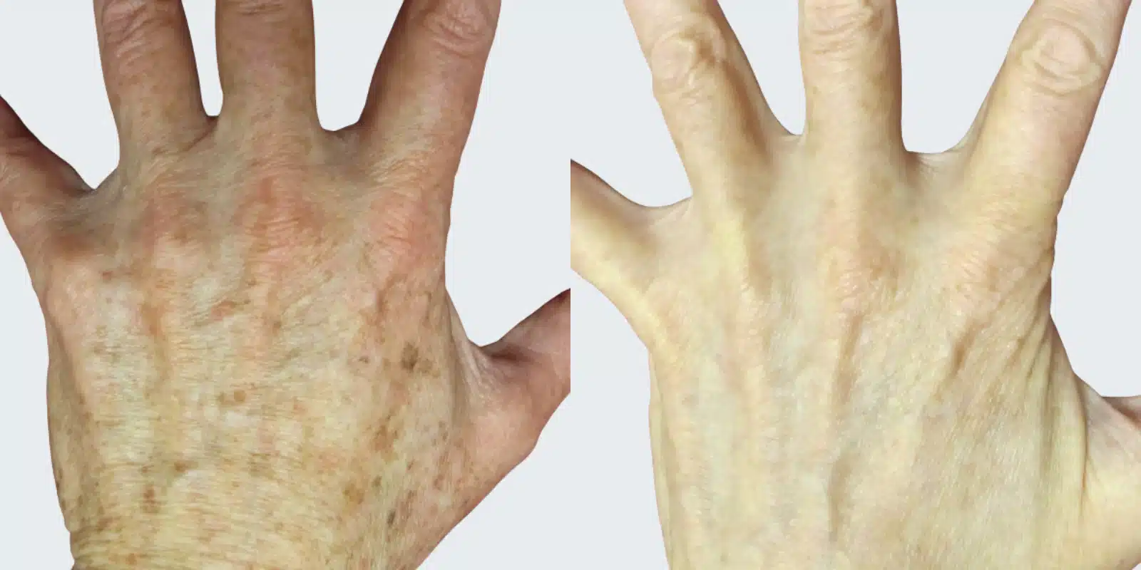 before and after results of bbl at revitalize skinmd before and after results of bbl at revitalize skinmd