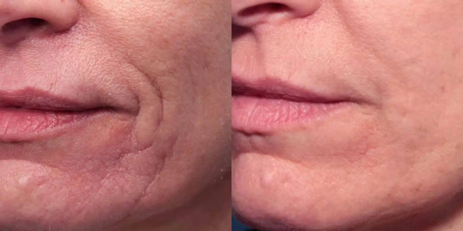 before and after results of genius rf microneedling at revitalize skinmd () before and after results of genius rf microneedling at revitalize skinmd ()