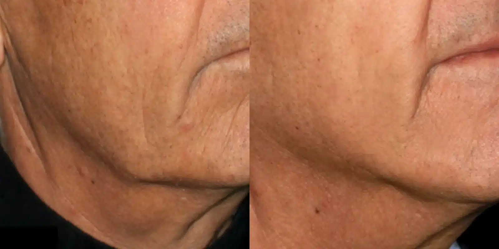 before and after results of genius rf microneedling at revitalize skinmd before and after results of genius rf microneedling at revitalize skinmd