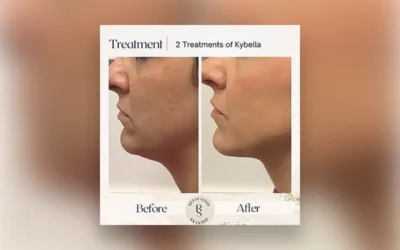 Say Goodbye to Double Chins with Kybella