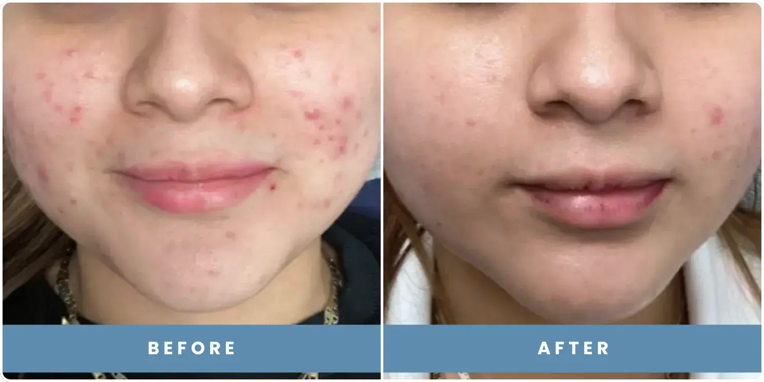 patient before and after results at revitalize skinmd
