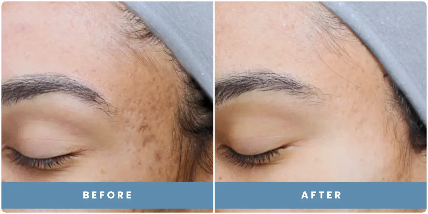 patient before and after results at revitalize skinmd