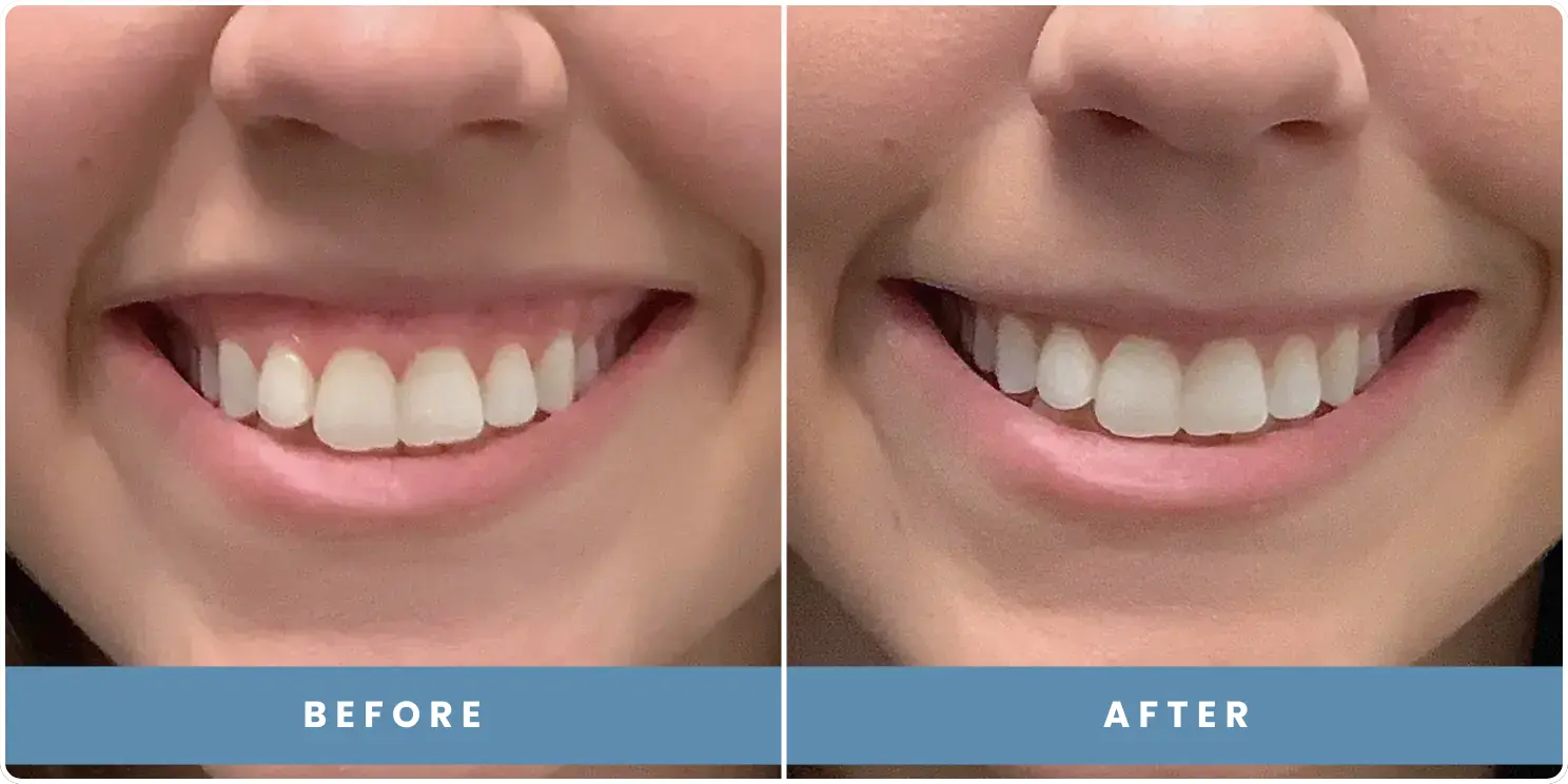 patient before and after results at revitalize skinmd